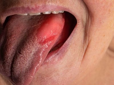 Penyakit Glositis