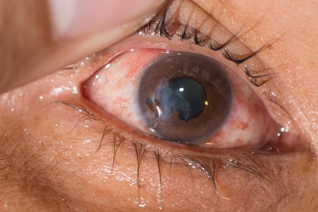 Hifema Dan Perawatan Medis, Kapan Harus Ke Dokter Mata?