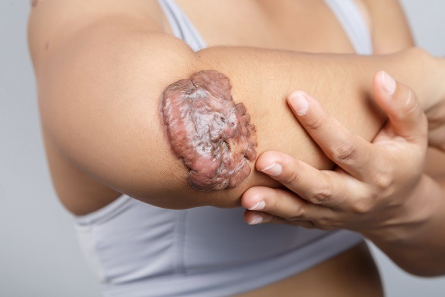 Benjol Keloid Bisa Turun-Temurun? Fakta Yang Harus Anda Tahu