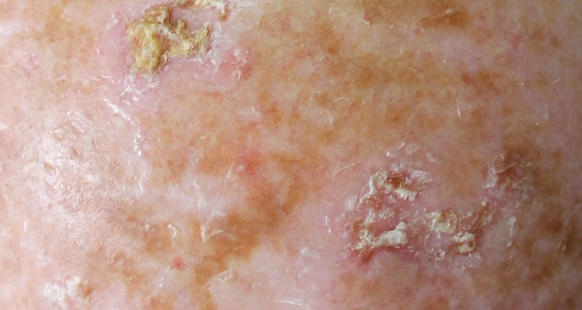 Actinic Keratosis, Lesi Kulit Akibat Paparan Sinar Matahari