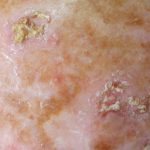 Actinic Keratosis, Lesi Kulit Akibat Paparan Sinar Matahari