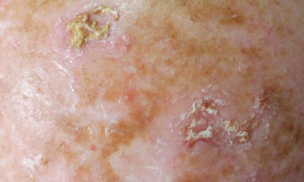 Actinic Keratosis, Lesi Kulit Akibat Paparan Sinar Matahari