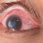 Endoftalmitis, Infeksi Mata Serius Yang Mengancam Penglihatan