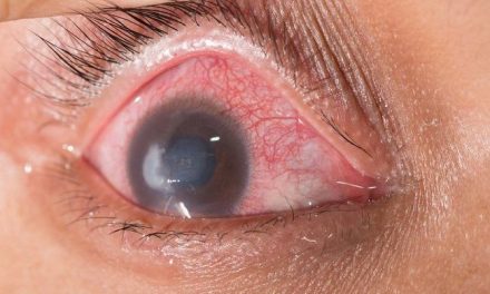 Endoftalmitis, Infeksi Mata Serius Yang Mengancam Penglihatan