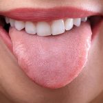 Glositis Bisa Terjadi Pada Siapa Saja, Ini Dia Gejala Dan Solusinya