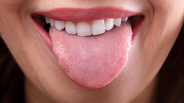 Glositis Bisa Terjadi Pada Siapa Saja, Ini Dia Gejala Dan Solusinya