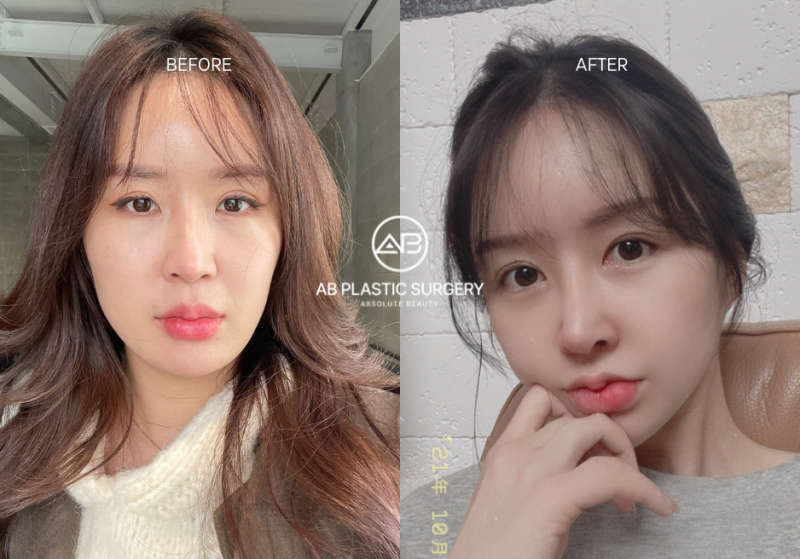 Operasi Plastik Eyelid