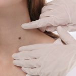 Kondisi Nevus, Tahi Lalat Yang Tampak Sepele Namun Berisiko