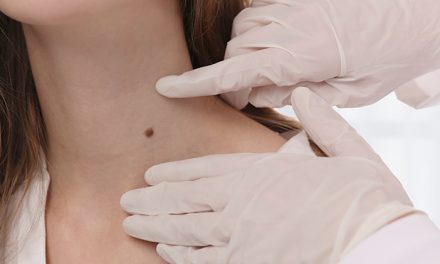 Kondisi Nevus, Tahi Lalat Yang Tampak Sepele Namun Berisiko